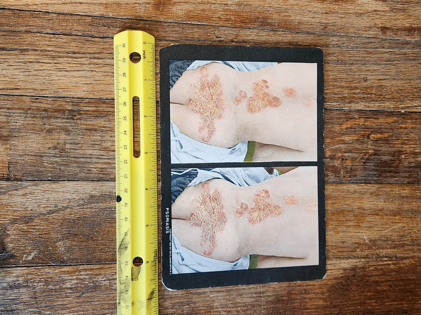 Antique Medical Teaching Card – Psoriasis – Dermatology Photo Plate c.1920s