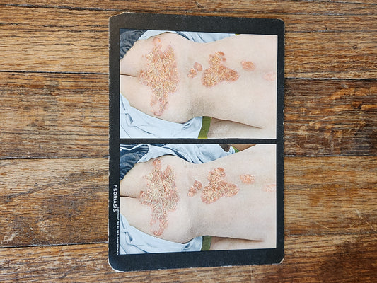 Antique Medical Teaching Card – Psoriasis – Dermatology Photo Plate c.1920s