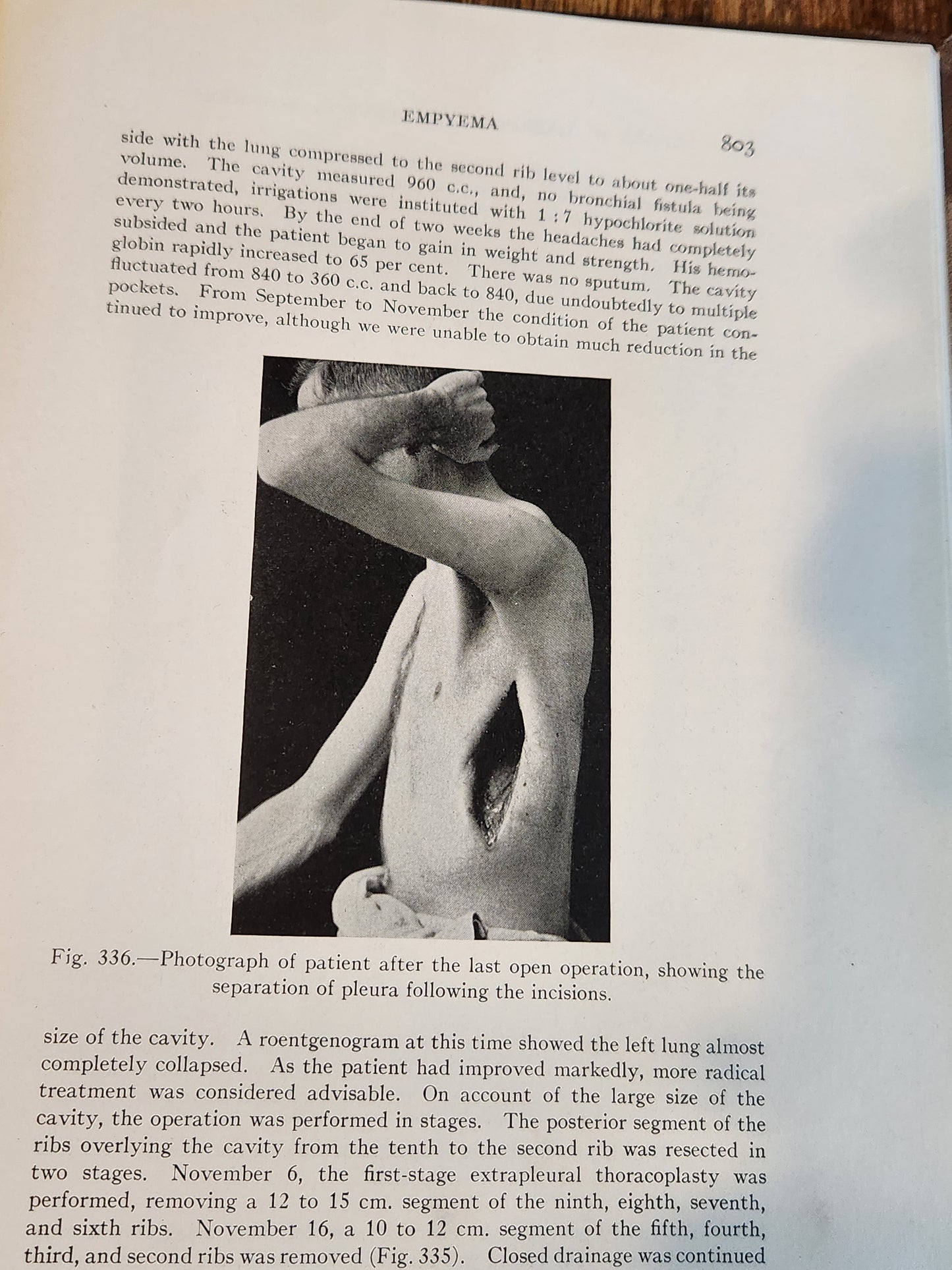 The Surgical Clinics of North America - June, 1925 – Volume 5, Number 3 (Mayo Clinic Issue)